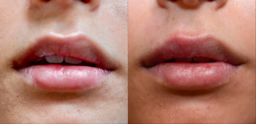 Lèvres avant après 13