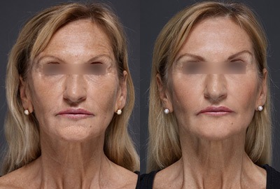 01-result-domini-before-after (1)