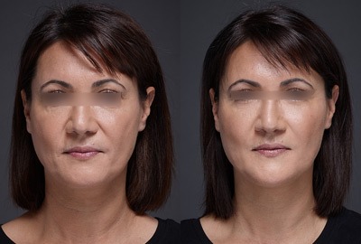01-result-naima-before-after-1 (1)