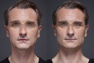01-result-renaud-before-after (1)