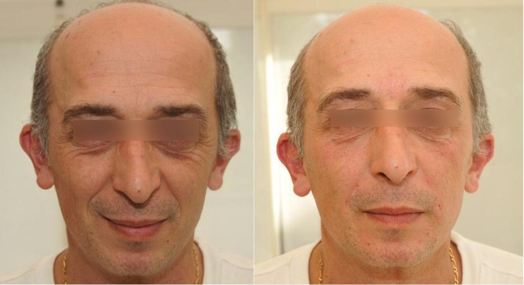 Homme-2-avant-Apres-1 (1)