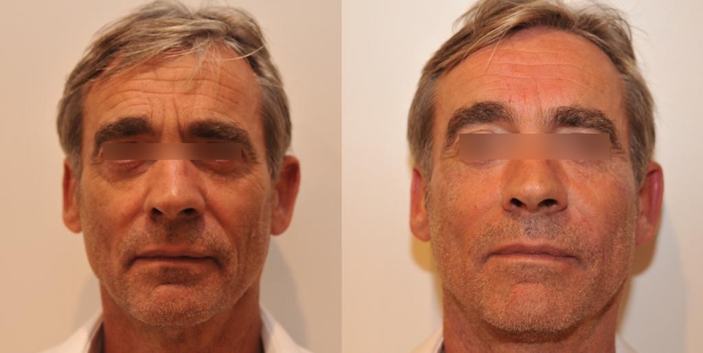 Homme-3-avant-Apres-1 (1)