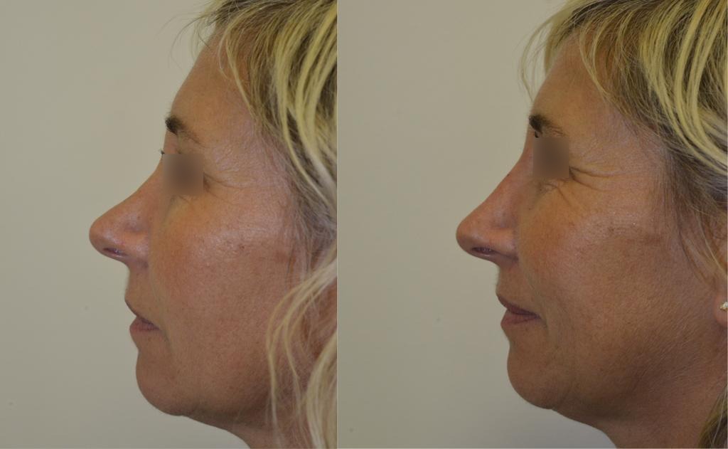 nez-avant-apres-profil-1-1 (1)