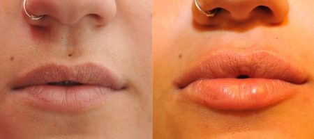 Injection d'acide hyaluronique appliquée aux lèvres.
